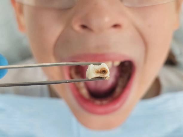 Best Emergency Root Canal Treatment in New Richmond, WI