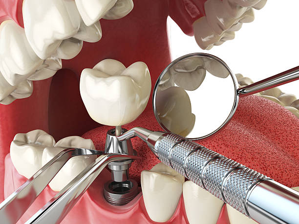 Best Urgent Care for Lost Fillings or Crowns in New Richmond, WI